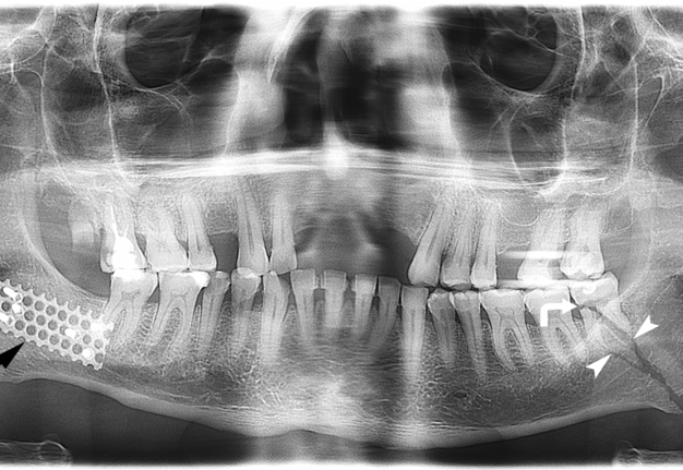 Mandibular Fracture X Ray