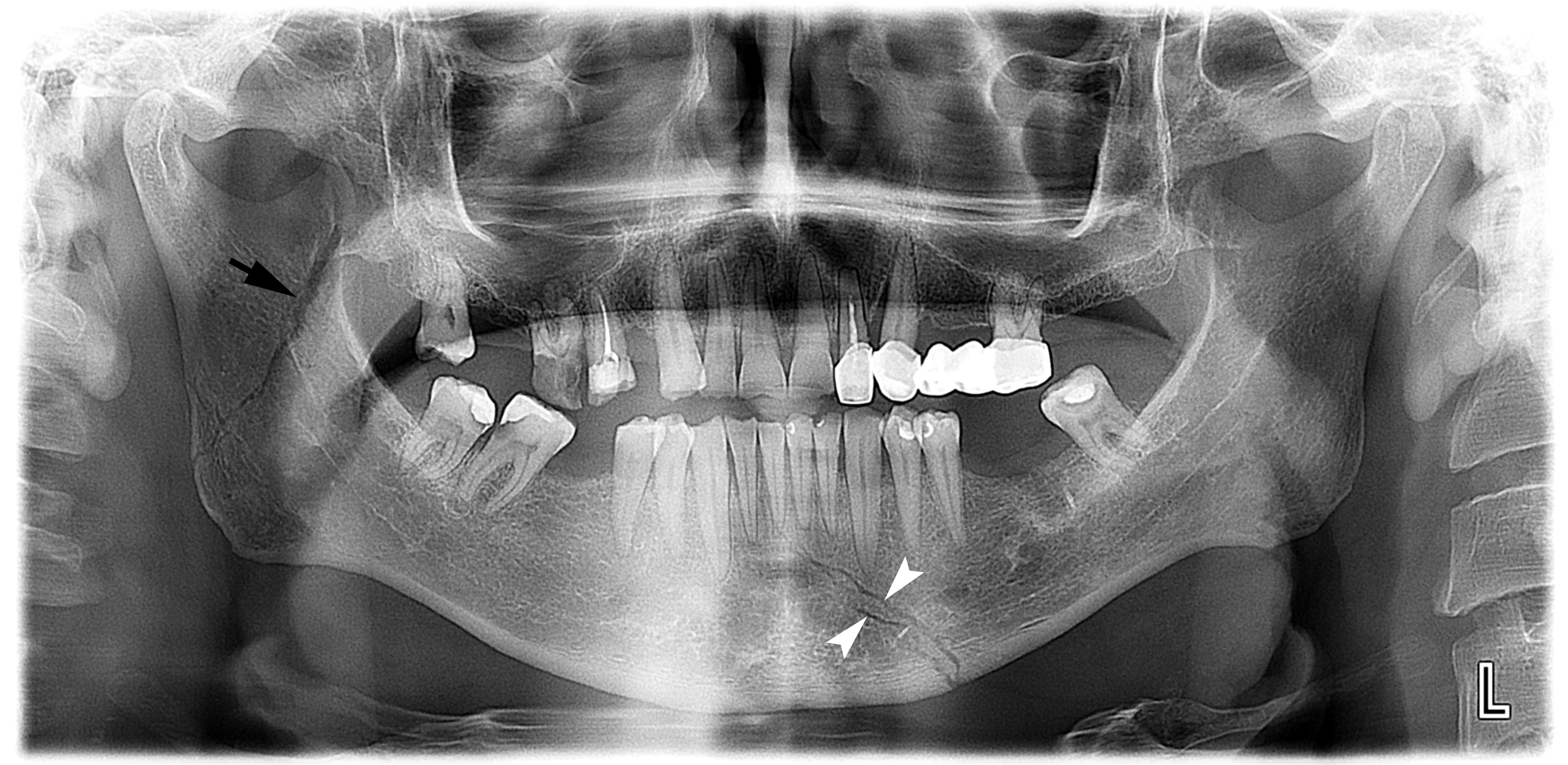 mandible fracture x ray